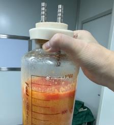 微山水动力吸脂手术要做多久？